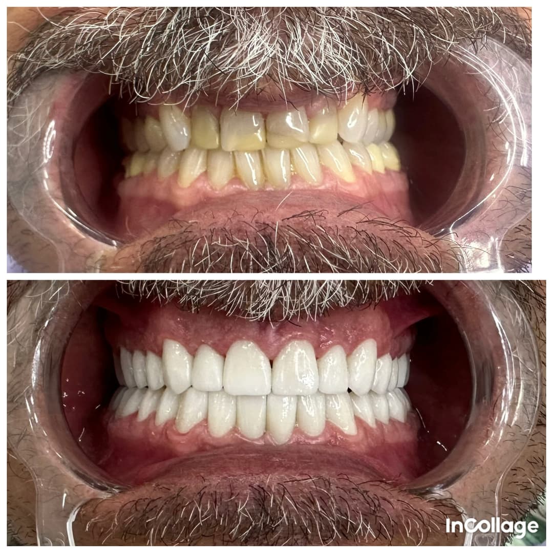 Cirkon krunice - slika 1