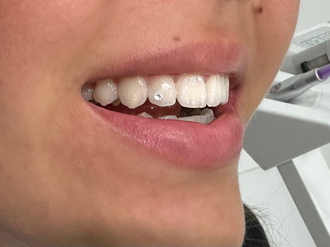 Cirkon - zubni nakit