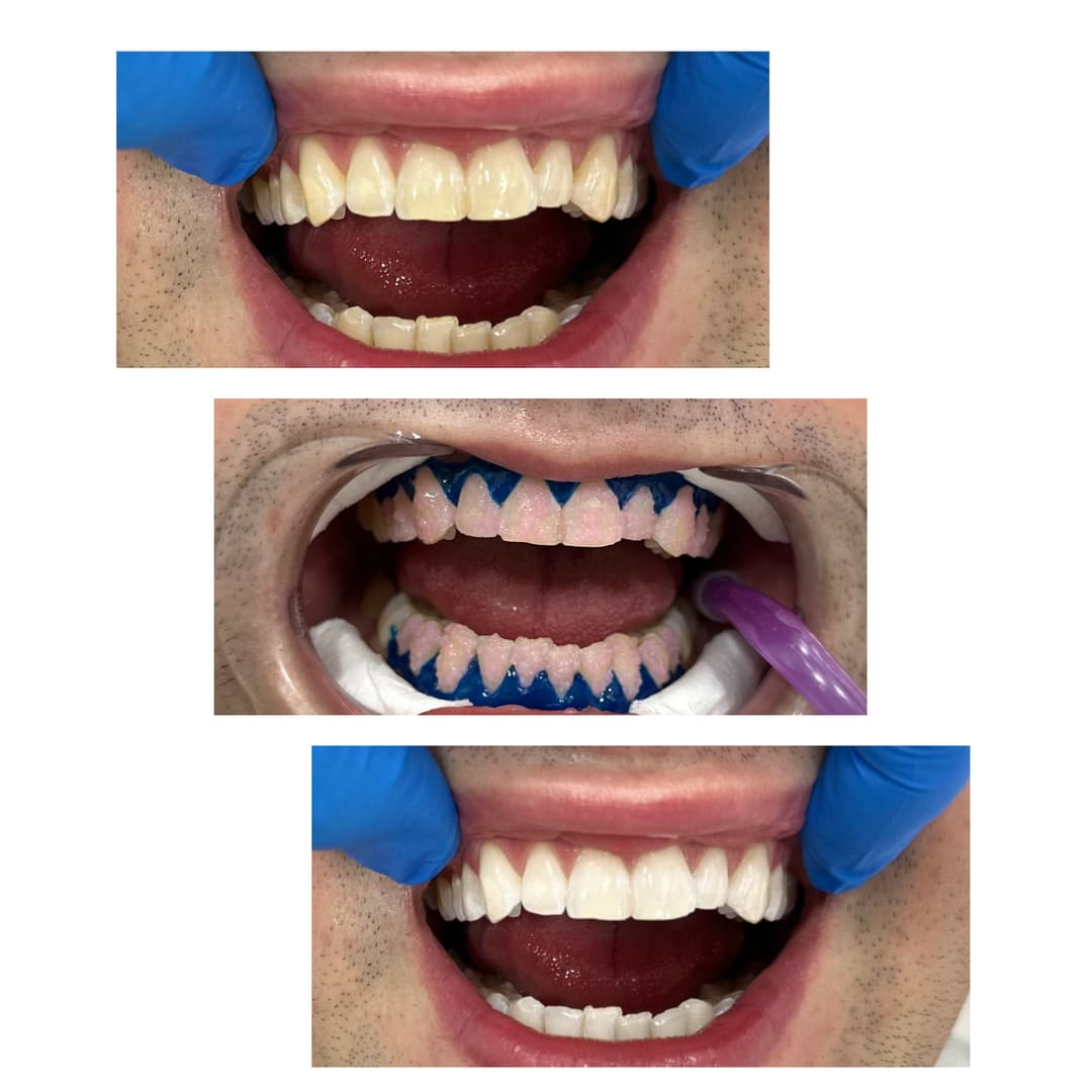 Izbeljivanje zuba - Egzogeno