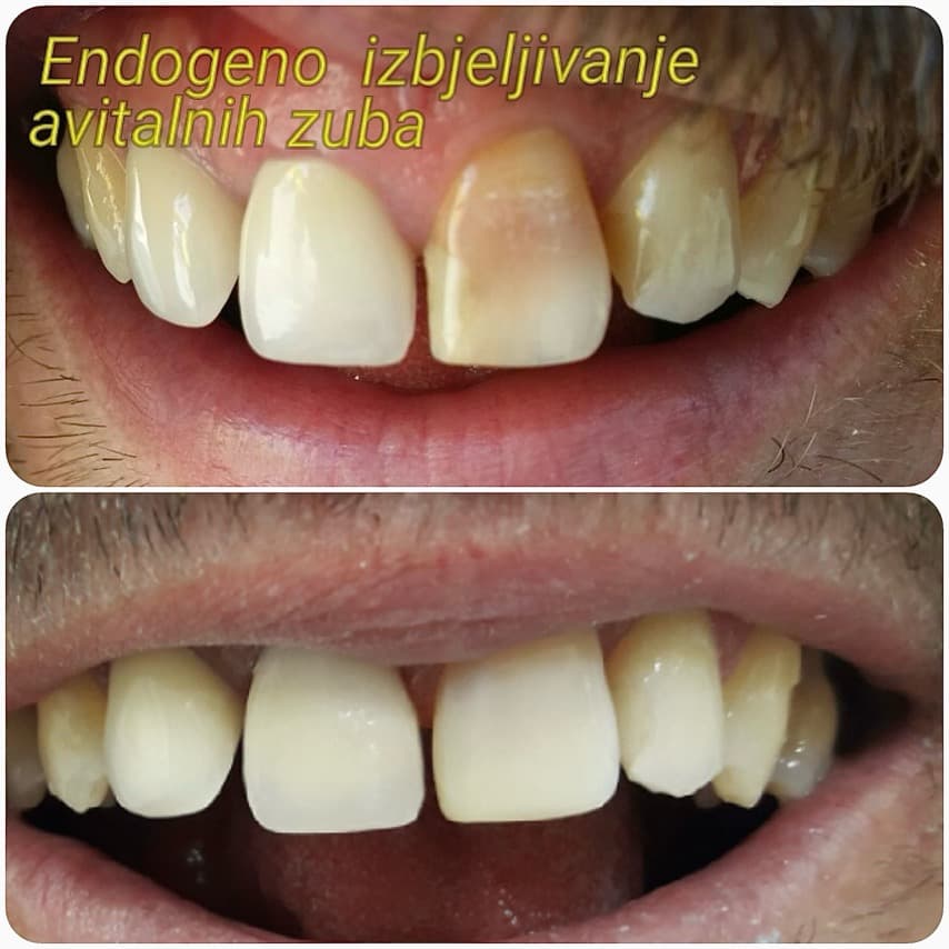 Izbeljivanje zuba - Endogeno