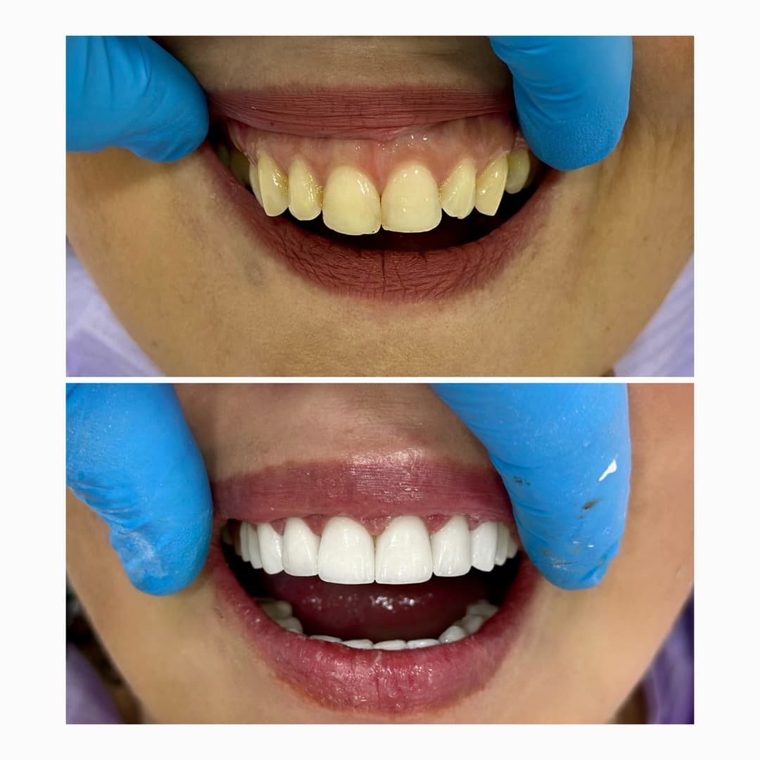 Zubne krunice i mostovi